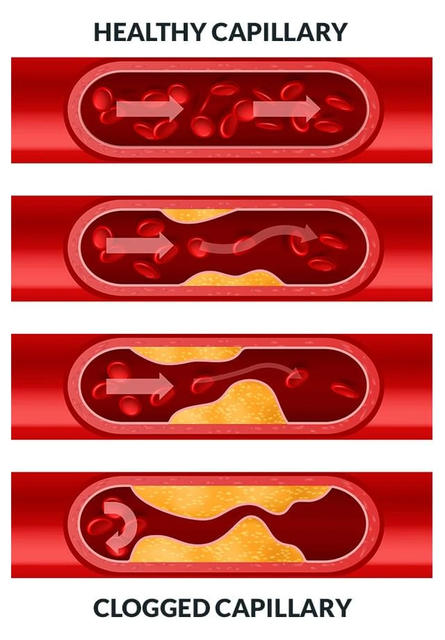 Illustration comparing a healthy open capillary with a clogged capillary to show blood flow